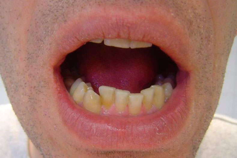 Anquiloglosia_adultos_post.jpg